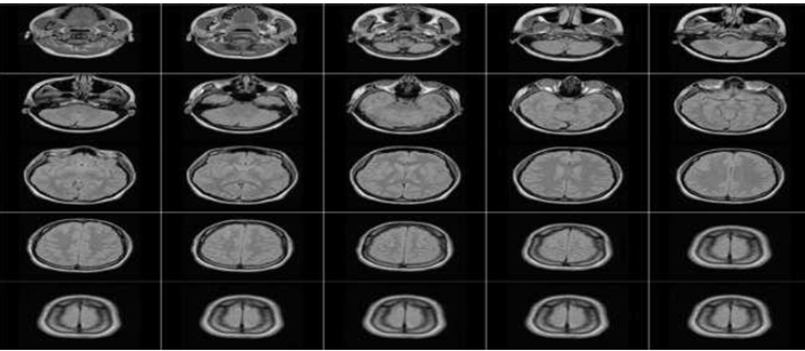 DICOM image of brain